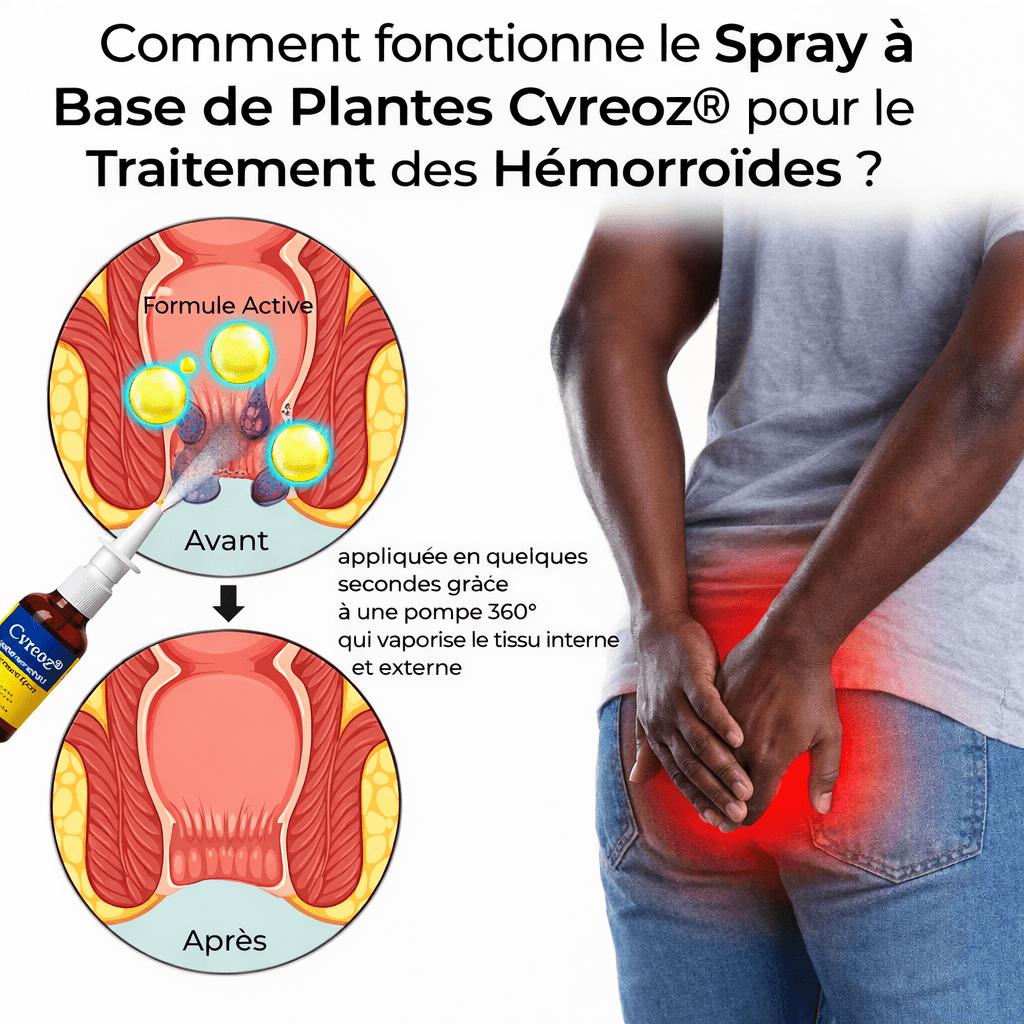 Spray anal pour le traitement des hémorroïdes à base de plantes - BOUTIQUE SN