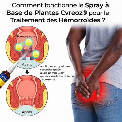 Spray anal pour le traitement des hémorroïdes à base de plantes - BOUTIQUE SN