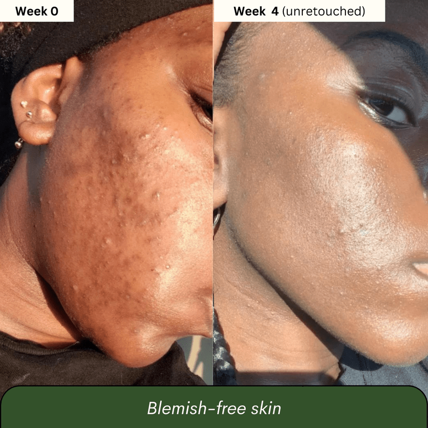 Savon au curcuma et à l’acide kojique - Éliminez 100% de vos taches sombres délicates et révélez une peau uniforme et lumineuse - BOUTIQUE SN
